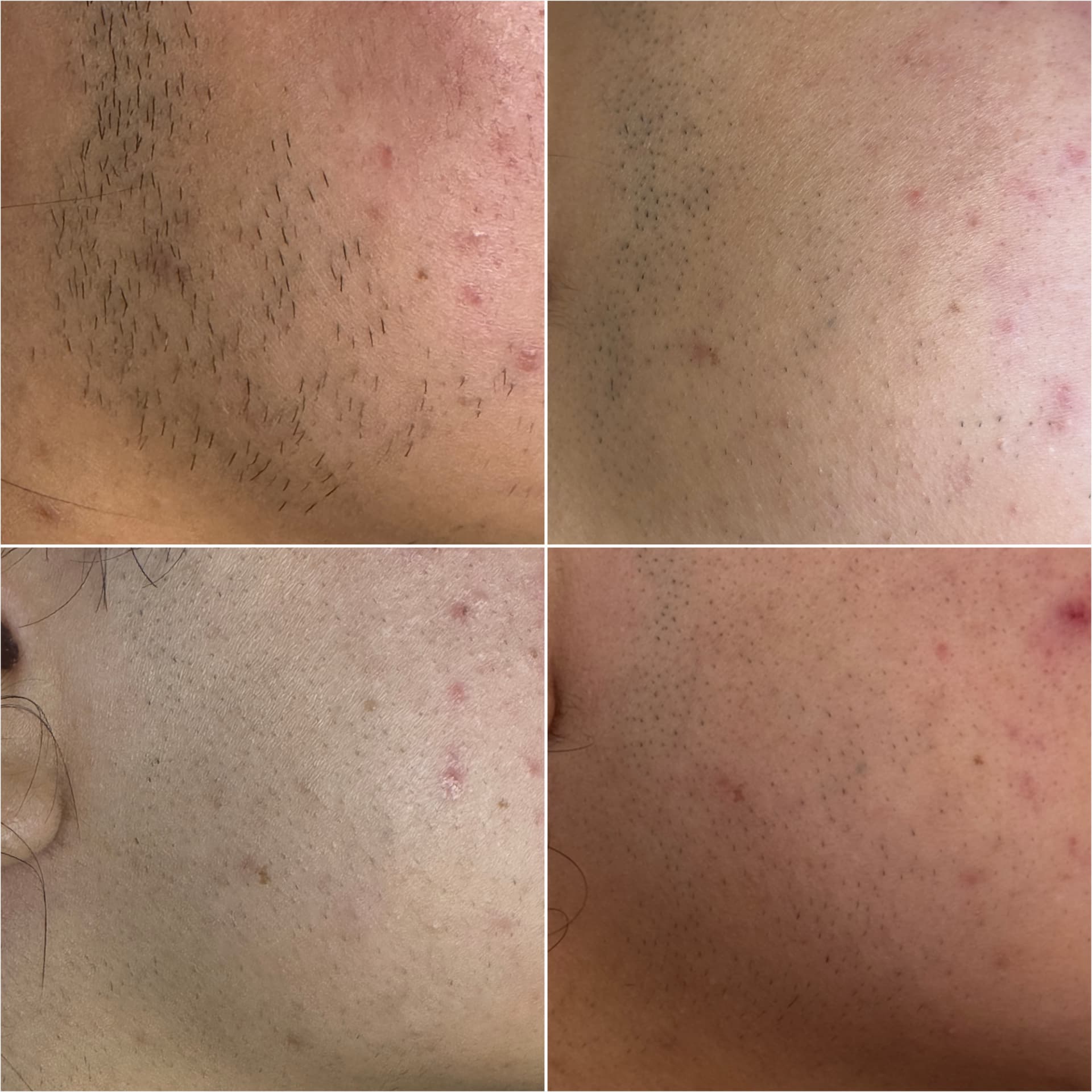 Chin and jawline before and after a course of laser hair removal