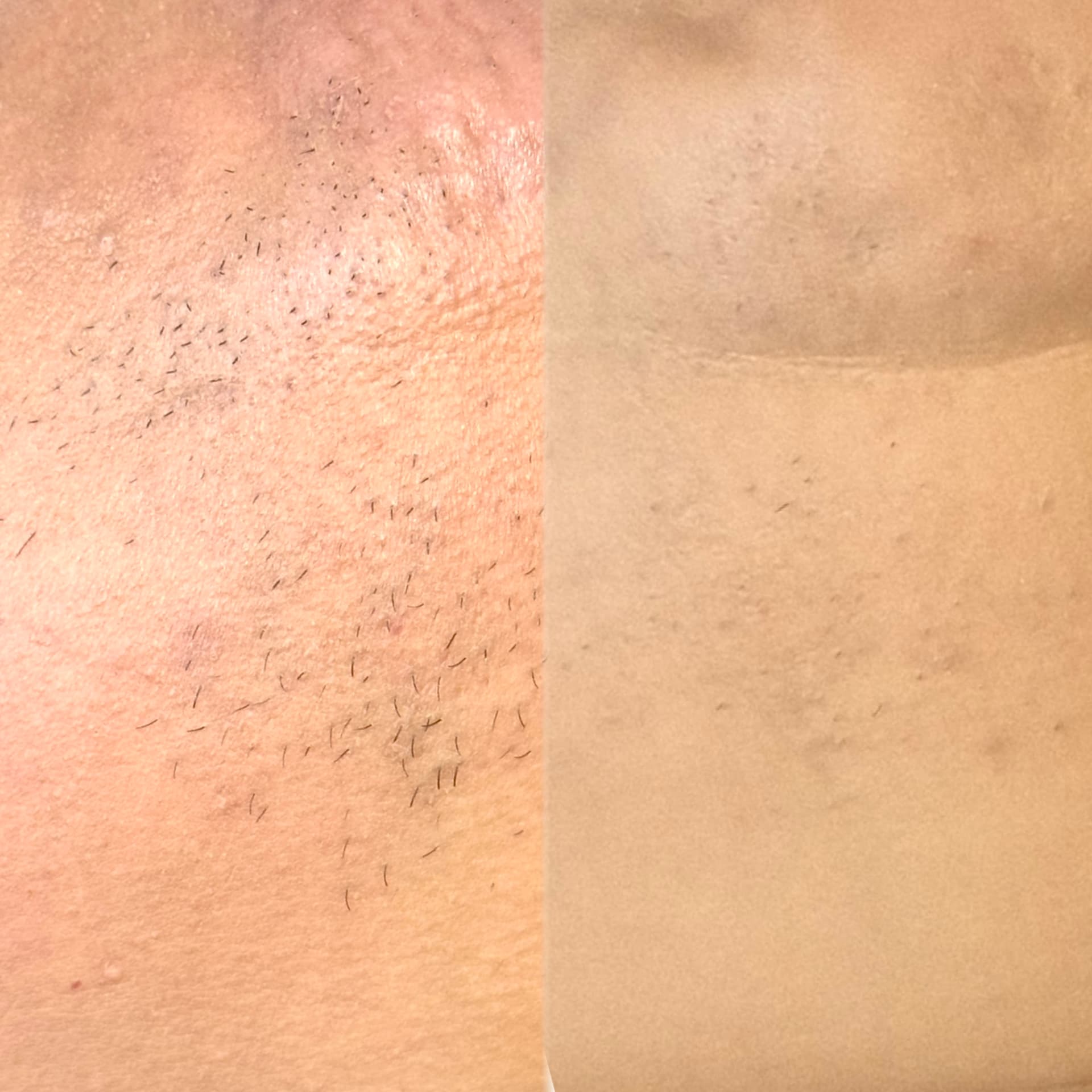 Bikini line before and after laser hair removal