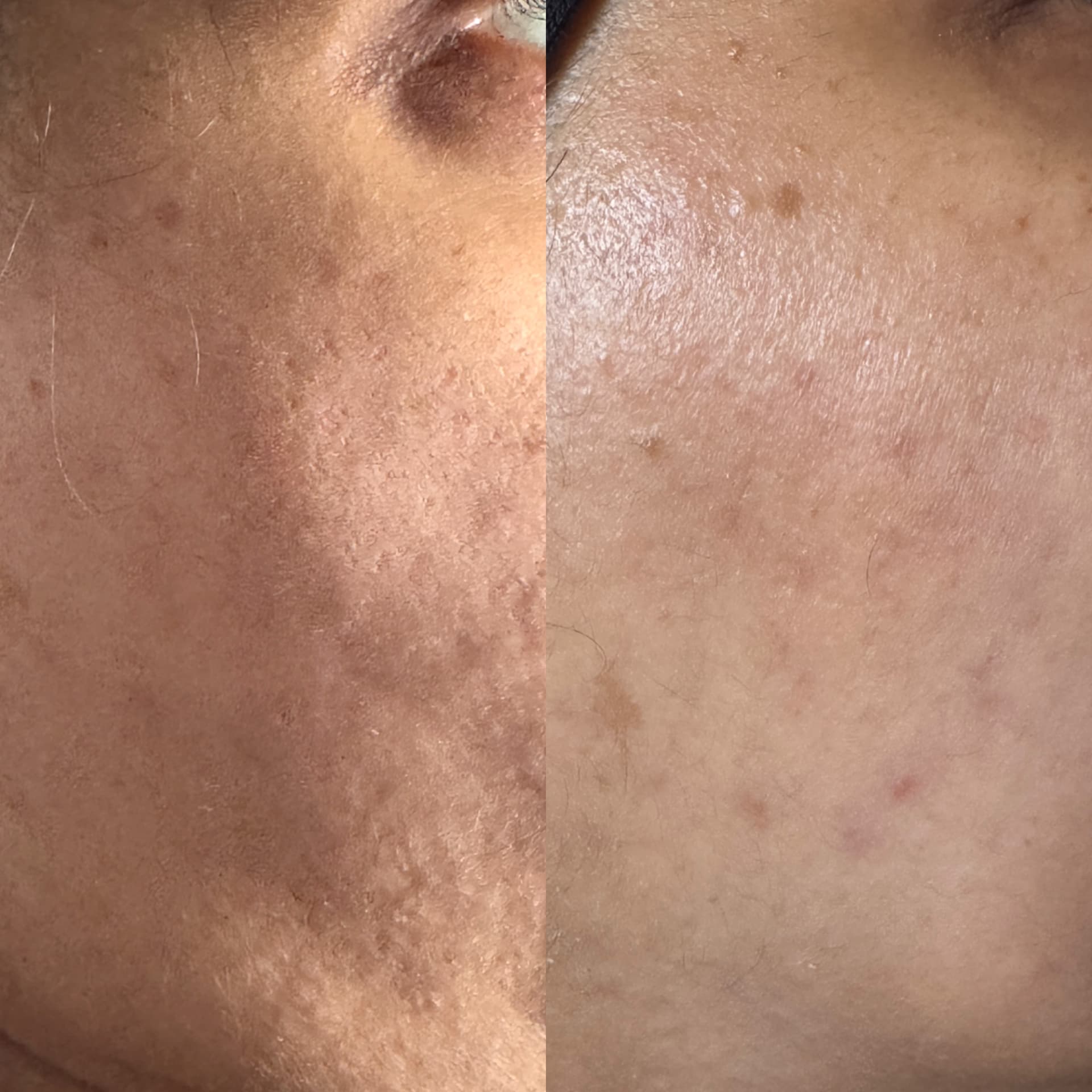 Cheek before and after a course of microneedling for acne scarring
