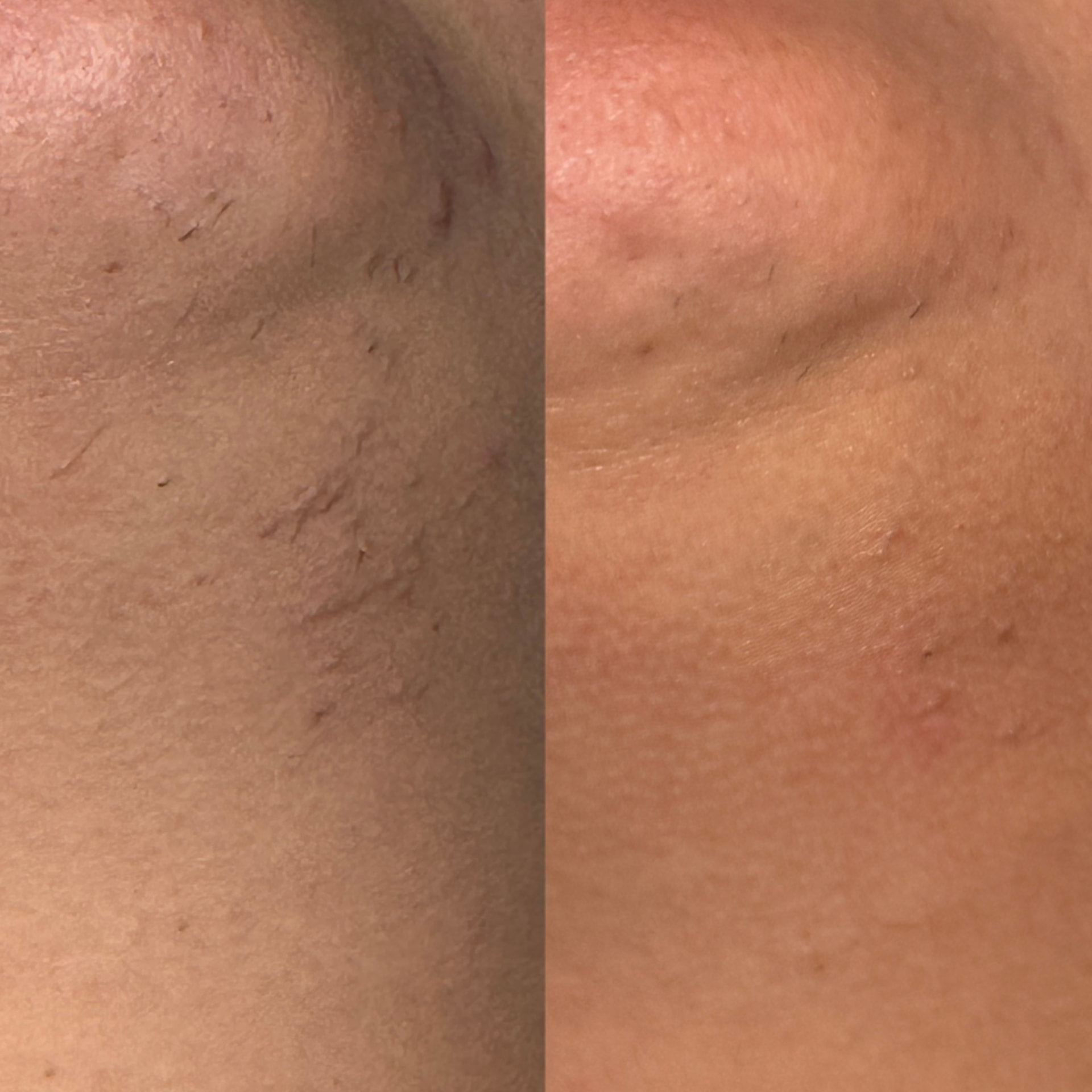 Underarm before and after a course of laser hair removal