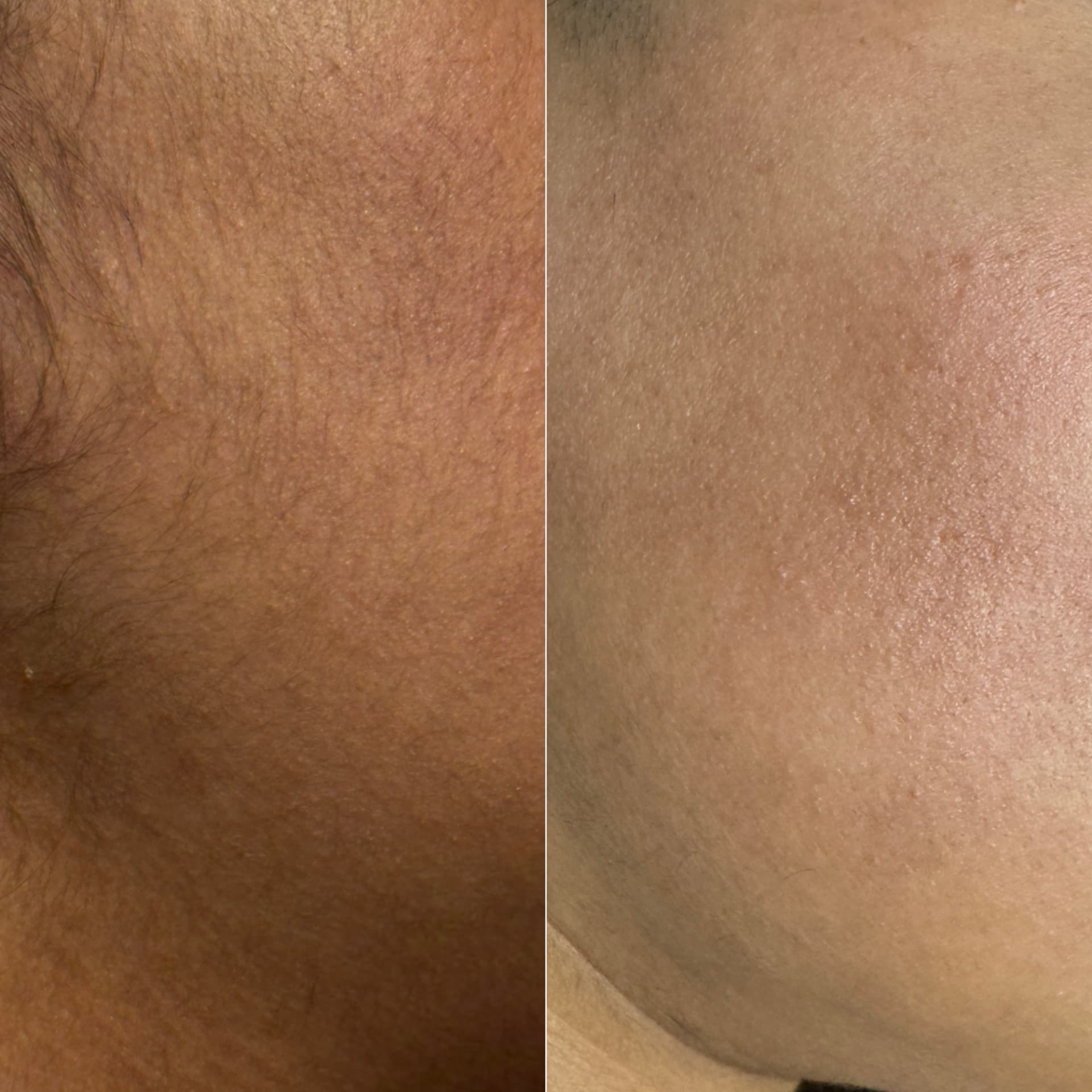 Underarm before and after laser hair removal