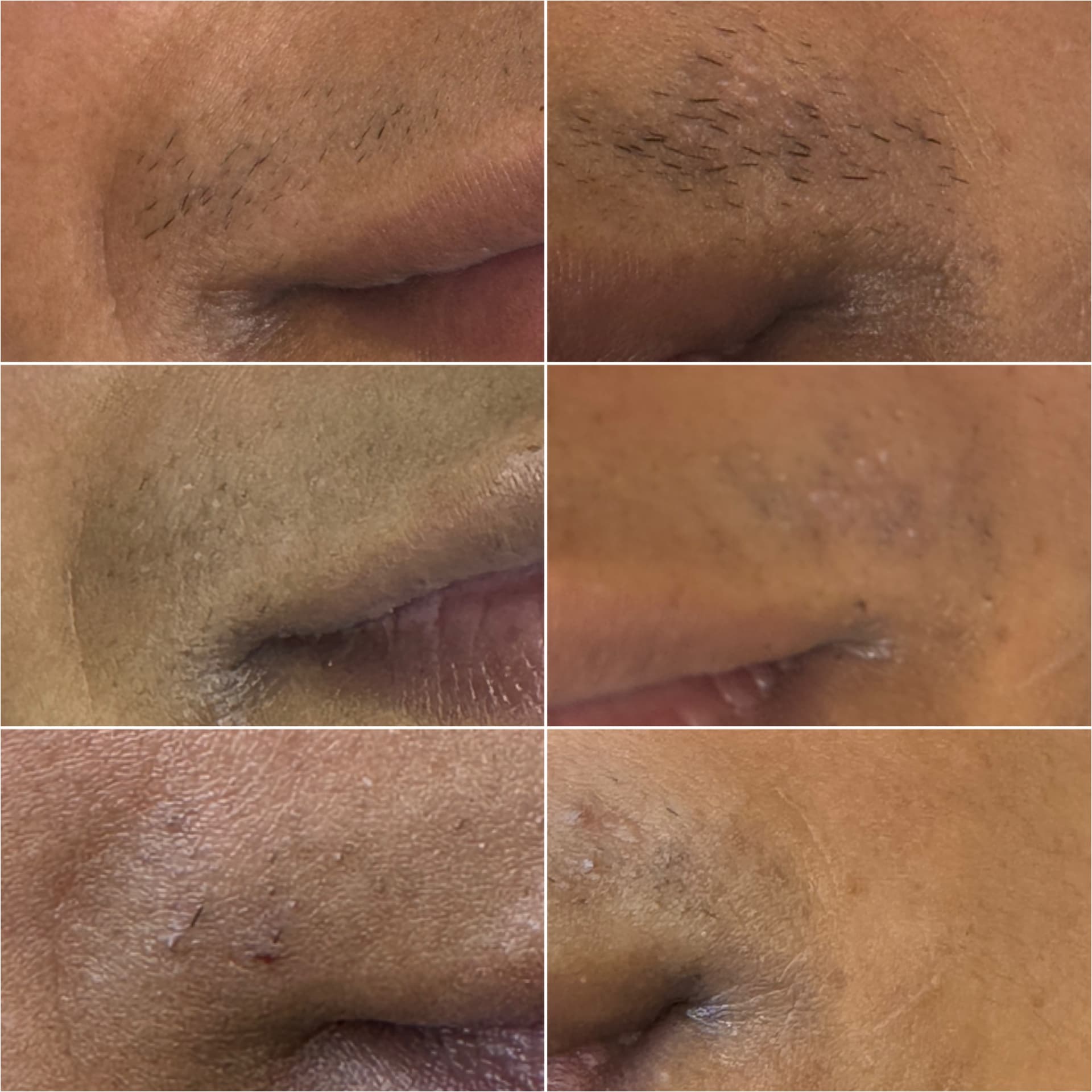 Upper lip before and after laser hair removal on deeper skin
